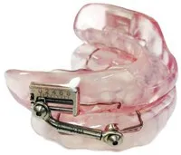 customized appliance for OAT treatment