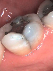 Intra Oral Camera example
