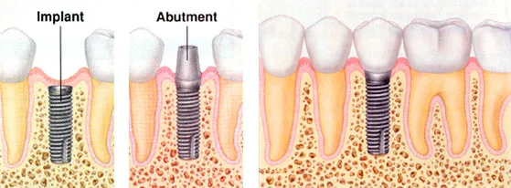 Dental Implant Illustration