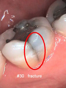 Intra Oral Camera example