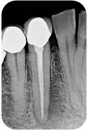 Digital Dental XRay Fort Collins CO